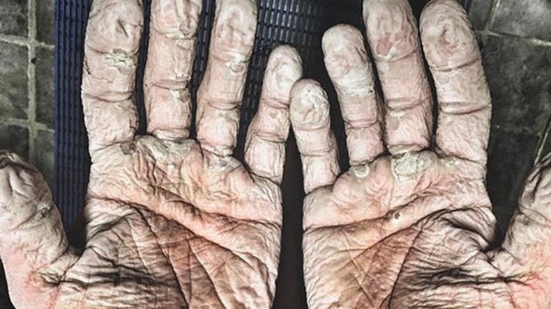 Olympic rower posts gruesome pic of blistered hands after record-breaking Arctic expedition