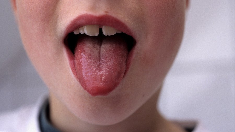 Scarlet fever cases at unexplained 50-year high