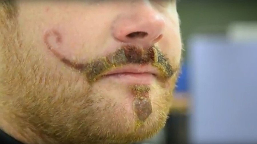 Whiskers galore: Allergic reaction to henna tattoo means Brit could have fake moustache for life