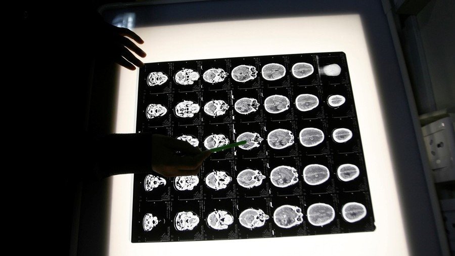Dementia revelation: Exercise ‘could worsen’ brain deterioration