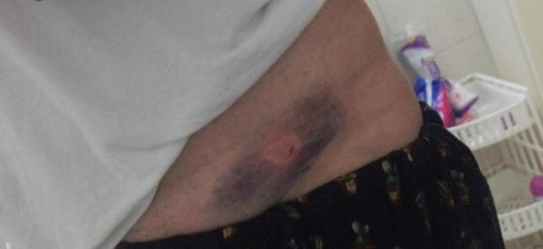 Bruises and wound on Foss's abdomen © Kristin Foss