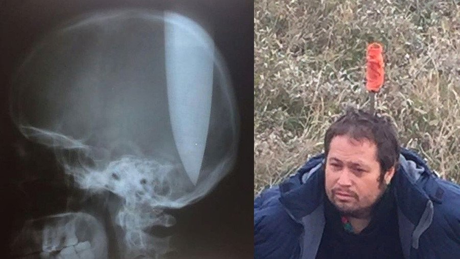 Russian man lodges 8-inch knife into skull to ‘help him breathe’… miraculously survives