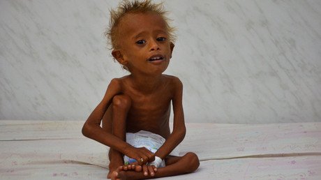 Saudi Arabia under spotlight over Khashoggi, but drastic Yemen famine ignored