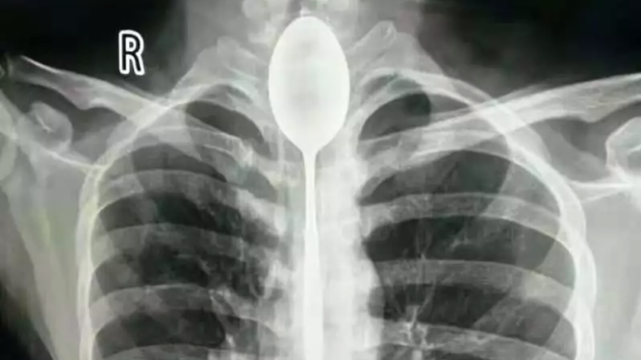 Say what? Man lives with 20cm spoon in throat for a year before seeking help (PHOTOS)