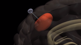 ‘Pied Piper’ device lures tumors out of the brain in ‘game changing’ breakthrough (VIDEO)