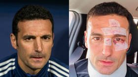 'A couple of points and home!' Argentina boss Scaloni posts picture of scars after being hit by car