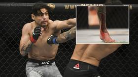 'His leg has a hole in it': UFC warrior Gabriel Benitez fights on with SHIN BONE visible through gaping wound in HORROR injury