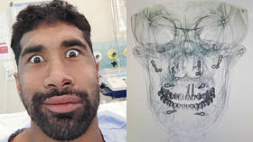 ‘Nailed it’: Rugby star laughs off having 20 SCREWS inserted in his face after gruesome injury