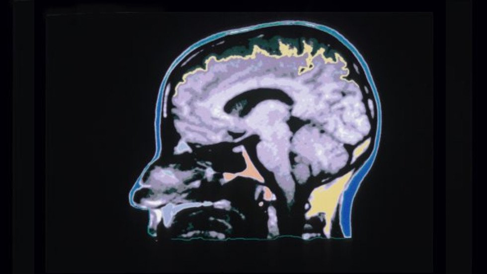 Мозг расширены. Институт психиатрии исследование импульсов мозга.