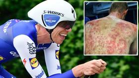 'These guys are TOUGH!' Cyclist reveals HORRIFIC bruises after riders caught in HAILSTORM at Criterium du Dauphine race (VIDEO)