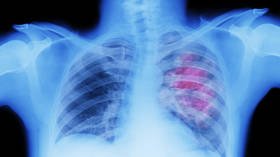 One in a hundred Covid-19 patients suffer punctured lung according to worrying new research