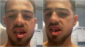 'It's not supposed to look like that': Boxer shows off horrific injury after fighting FIVE ROUNDS with BROKEN JAW (GRAPHIC)
