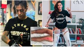 ‘You might lose your legs’: Rising MMA star Athena Martinez suffers horrific BURNS in cryotherapy treatment gone wrong