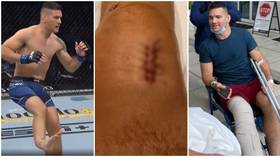 ‘Bone went through skin’: UFC’s Chris Weidman shows scars from horror leg injury as he reassures fans ‘I will be good’ (GRAPHIC)