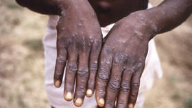Rare monkeypox outbreak: What you need to know