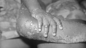 Israel reports first monkeypox case