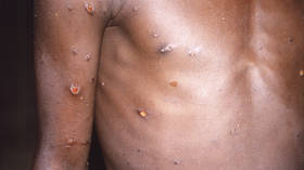 WHO issues forecast on monkeypox transmission