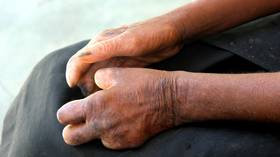 CDC issues leprosy alert