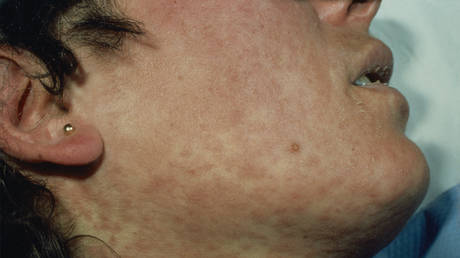 US measles cases hit 35-year high