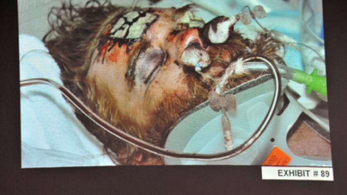 An evidence photo of beating victim Kelly Thomas in hospital, as it was shown during a preliminary hearing on his death, for Fullerton police officers Manuel Ramos and Jay Cicinelli at the Orange County Superior Court in Santa Ana, California May 7, 2012 (Reuters / Joshua Sudock / Pool)