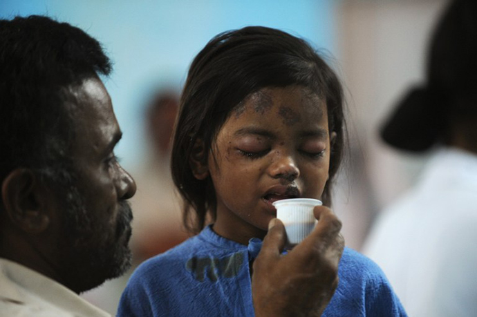 Sandhya, 4, a survivor of a building collapse, recovers at a hospital in Thane, on the outskirts of Mumbai on April 5, 2013. (AFP Photo / Punit Paranjpe)