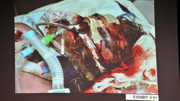 An evidence photo of beating victim Kelly Thomas in hospital, as it was shown during a preliminary hearing on his death, for Fullerton police officers Manuel Ramos and Jay Cicinelli at the Orange County Superior Court in Santa Ana, California May 7, 2012. (Reuters / Joshua Sudock / Pool)