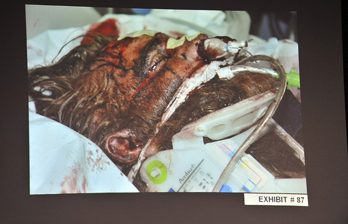 An evidence photo of beating victim Kelly Thomas in hospital, as it was shown during a preliminary hearing on his death, for Fullerton police officers Manuel Ramos and Jay Cicinelli at the Orange County Superior Court in Santa Ana, California May 7, 2012. (Reuters / Joshua Sudock)