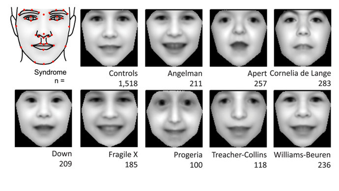 Key to ultra-rare genetic disorders? Scientists create face recognition software for better diagnosis
