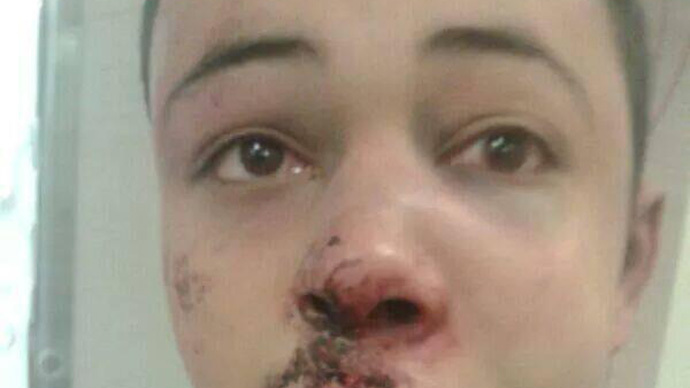 US ‘profoundly troubled’ by brutal beating of Palestine teen who turned out to be American