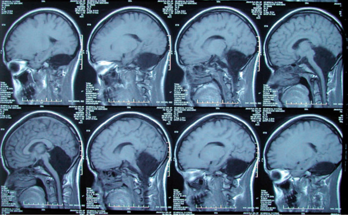 MRI scans of a female brain â the ninth case in medical history, when a relatively healthy person has no cerebellum (âA new case of complete primary cerebellar agenesis: clinical and imaging findings in a living patientâ, Feng Yu et al, Brain journal, August 2014)