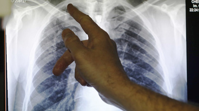 Tuberculosis epidemic much worse than people think – WHO