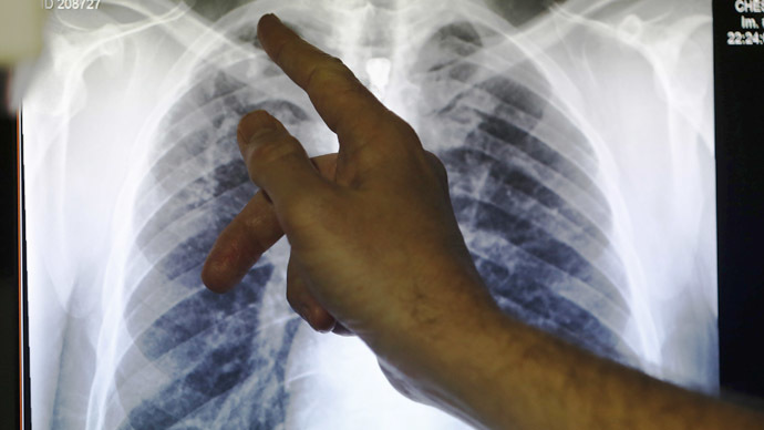 Over 700 infants potentially exposed to TB at Texas hospital