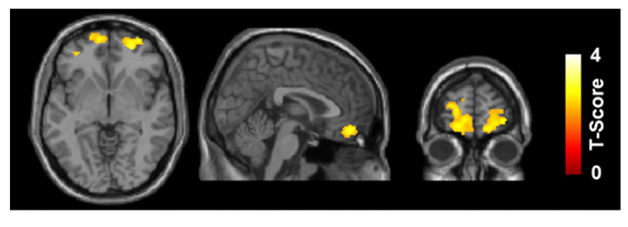 Group comparison of the gray matter volume demonstrates significant reduction in bilateral orbitofrontal gyri in marijuana users (Image from the study published in PNAS on November 10)