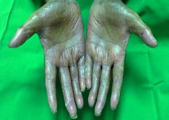 Grade 3 handâfoot syndrome with shedding of the skin of both palms (Oncologist/Dr. Mahmoud S. Al-Ahwal)