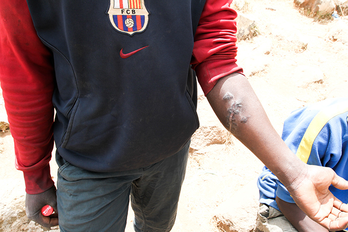 Mamadou, from Mali, with scars resulting from a beating by Moroccan soldiers. Photo by @TomasoClavarino