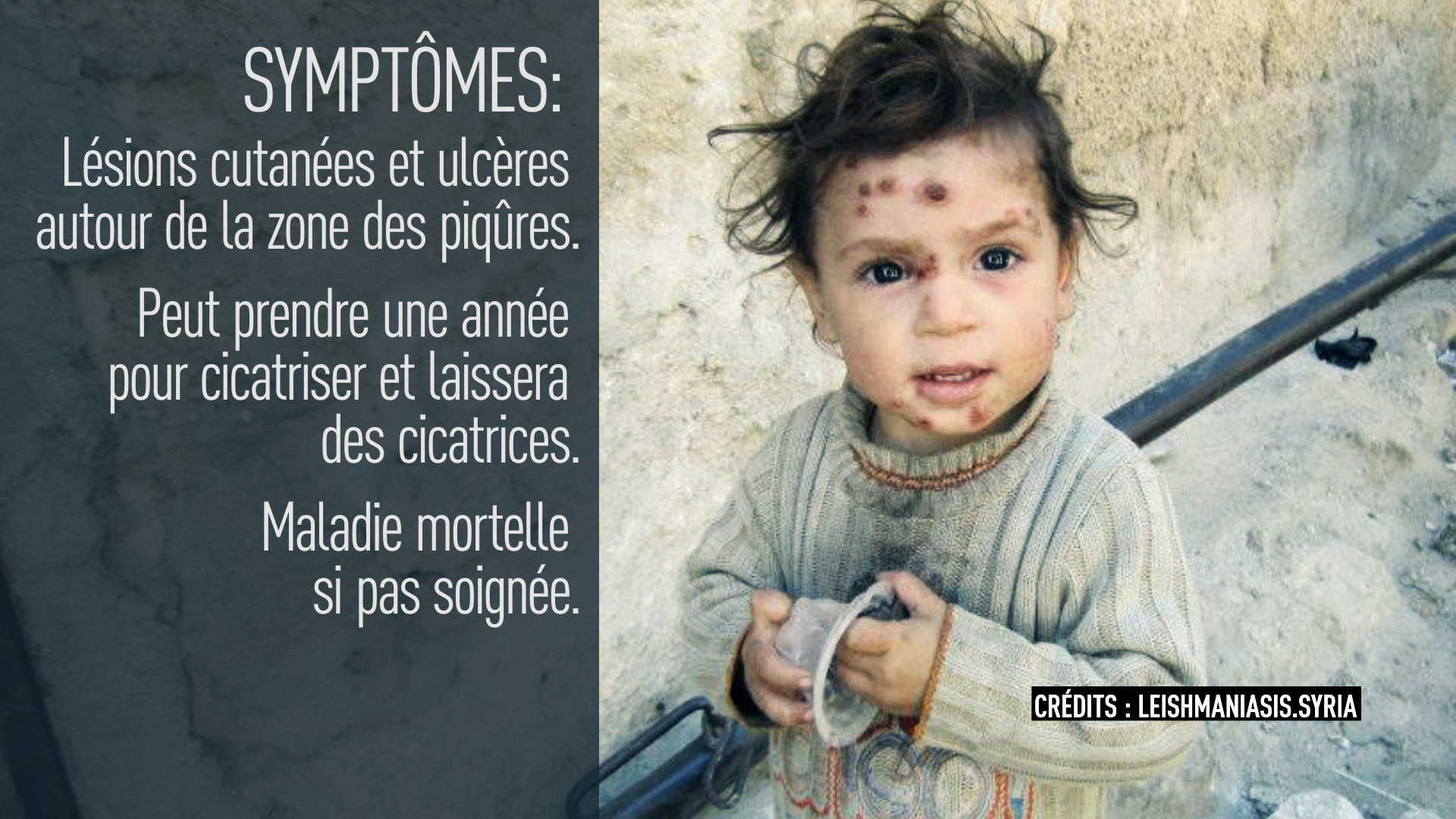 Syrie : alerte à la maladie dévoreuse de chair (IMAGES PERTURBANTES)