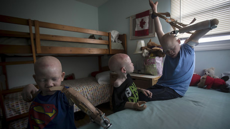 Vague d'agressions contre les albinos au Malawi