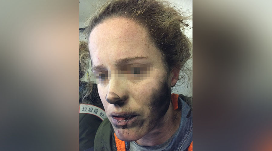Des écouteurs explosent en plein vol et brûlent une femme au visage (PHOTOS)