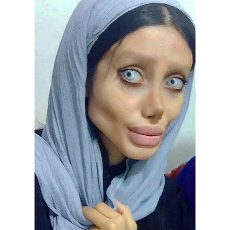 D'Angelina Jolie à «zombie» ? Les troublants résultats de la chirurgie esthétique d'une Iranienne