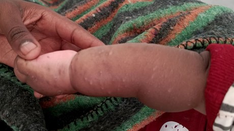 RDC : l'UNICEF met en garde contre l'aggravation de la crise, sur fond des violences du M23 et de la propagation des épidémies