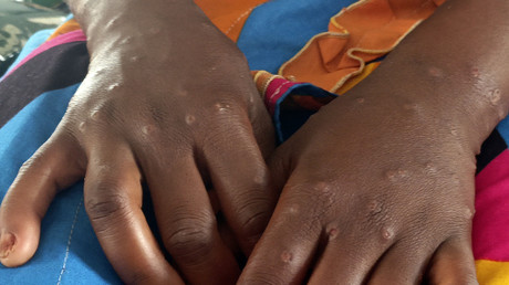Sénégal : un cas de Mpox confirmé à Dakar relance la vigilance en Afrique de l’Ouest