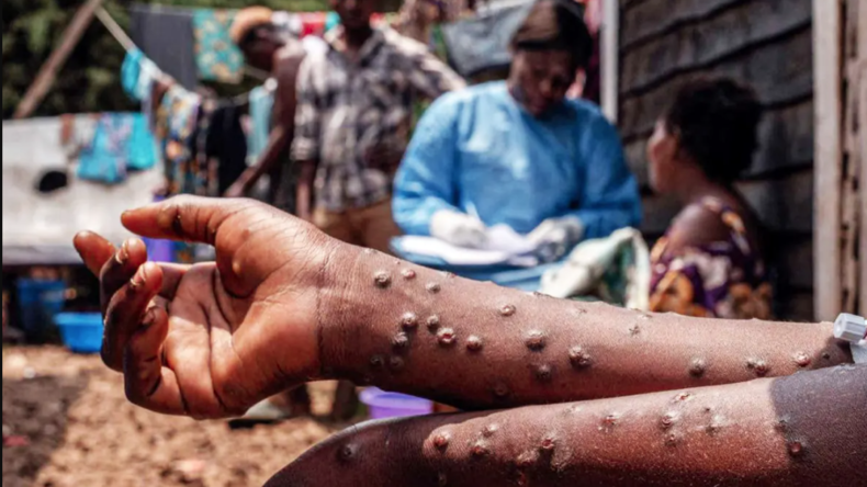 L’épidémie de mpox se propage de Madagascar aux îles voisines