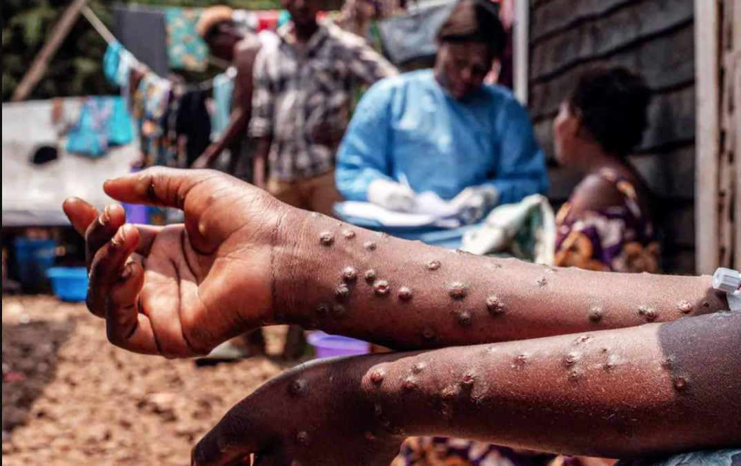 L’épidémie de mpox se propage de Madagascar aux îles voisines