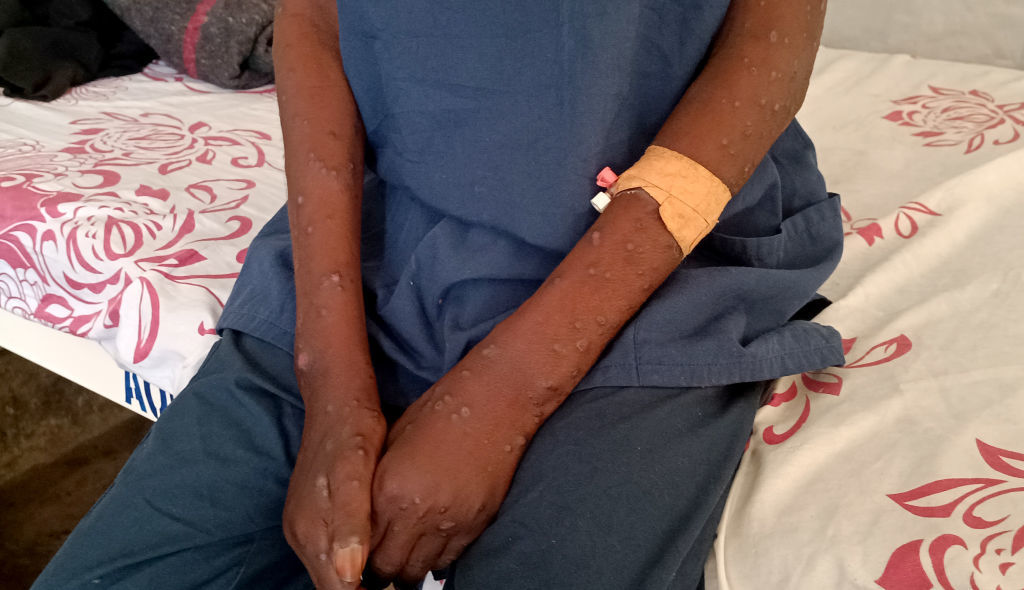 RDC : 245 nouveaux cas suspects de mpox, dont 24 confirmés, fin janvier 2026