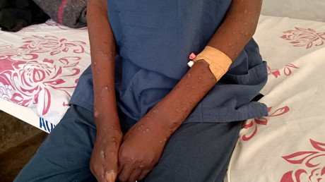 RDC : 245 nouveaux cas suspects de mpox, dont 24 confirmés, fin janvier 2026