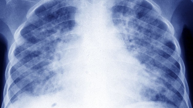 France : «une situation de tuberculose» déclarée en région parisienne, des dépistages organisés pour les cas contacts