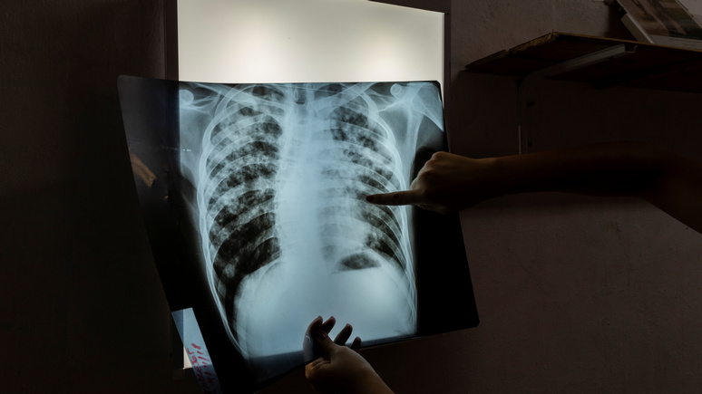 CNBC: следующий удар по человечеству — после коронавируса миллионам людей грозит туберкулёз