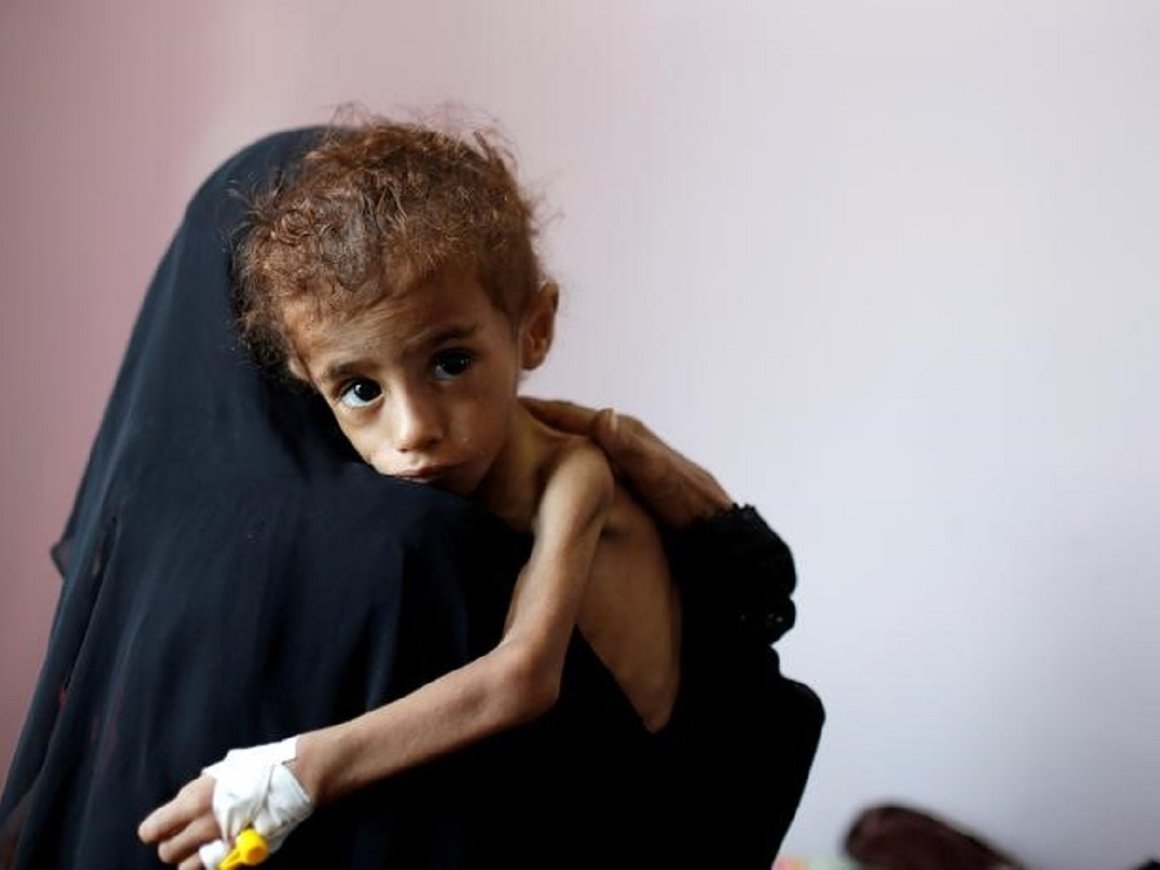 В Йемене за 3 года погибли 85 000 детей младше 5 лет