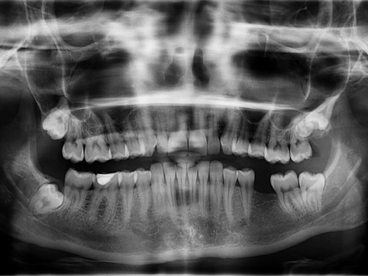 Стоматологи удалили более 500 зубов из челюсти 7-летнего мальчика (видео)