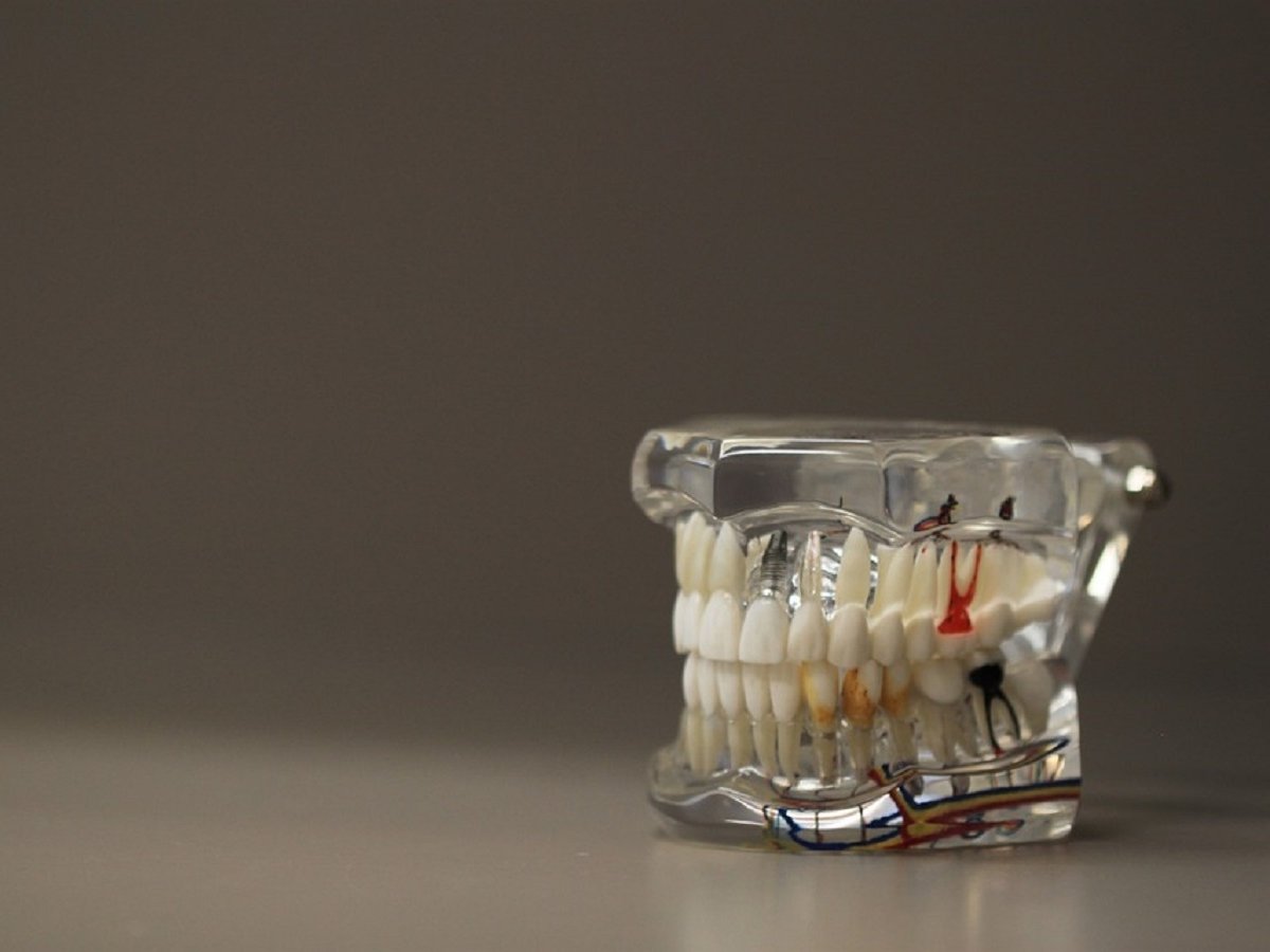 Разрушающиеся зубы можно восстановить. Но это не повод запускать их здоровье